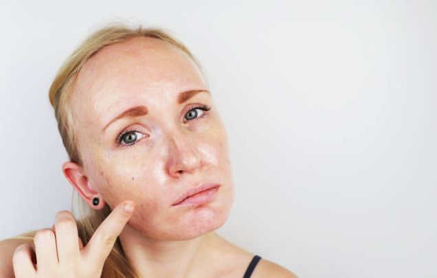 Home Remedies For Oily Skin That Work Well