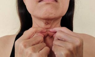 How To Treat Neck Wrinkles? 6 Effective Ways to Treat Them